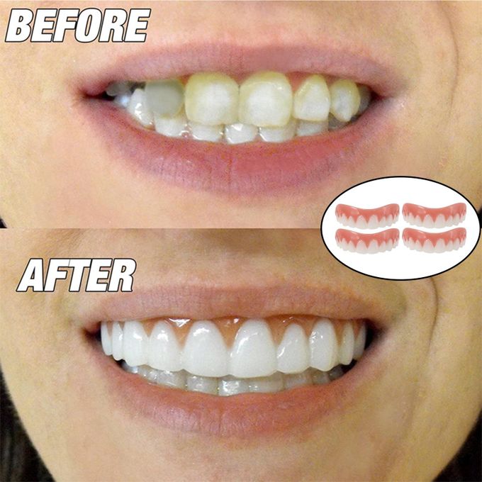 Instant Smiling Braces False Teeth Dental Veneers Tooth Cover